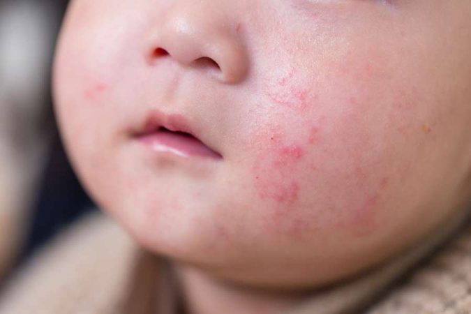 Gros plan sur le visage d'un nourrisson présentant des rougeurs sur la joue, illustrant la peau sensible d'un bébé.